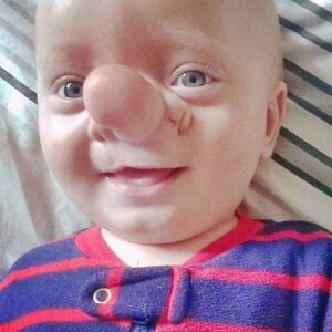 This baby’s nickname was Pinocchio and check out what he looks like years later…