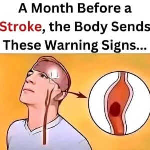 A Month Before a Stroke…