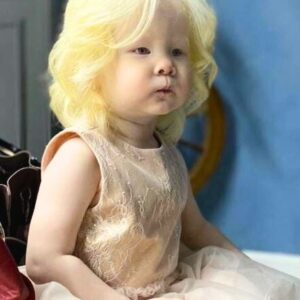 Albino Sisters Born 12 Years Apart Become Worldwide Sensations