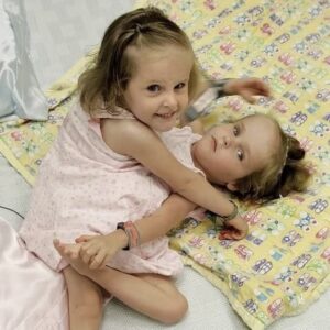 These Siamese Twins were Separated when They were 4 Years old: How are They Doing Now?