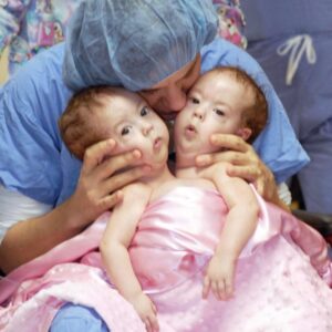 Conjoined Twins Bella And Abby Were Genuinely Associated From Birth, Yet Medical Procedure Changed Everything