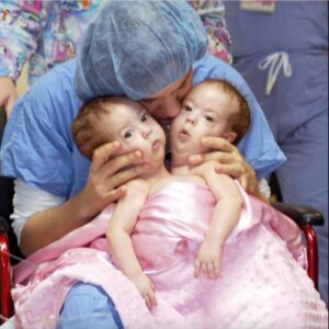 Conjoined Twins Bella And Abby Were Genuinely Associated From Birth, Yet Medical Procedure Changed Everything