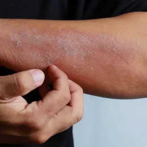 If you see these painful red bumps, you may have dyshidrotic eczema