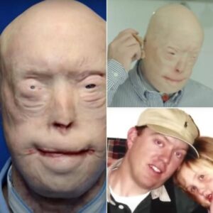 Firefighter suffers third-degree burns – this is him 7 years later Firefighter suffers third-degree burns – this is him 7 years later