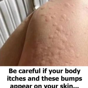 Why do hives appear on the skin? These are the surprising factors you might not know about. Why do hives appear on the skin? These are the surprising factors you might not know about.