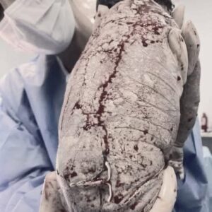 Baby born with an DIU peg…