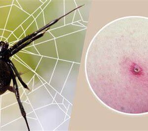 What to do if you get bit.ten by a black widow spider: A complete guide