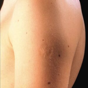 Smallpox vaccine scars: What they look like and why Smallpox vaccine scars: What they look like and why