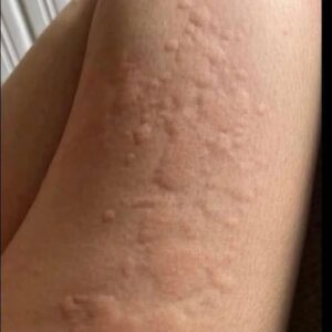 His whole body was itchy, he thought it was an allergy and was diagnosed…See more