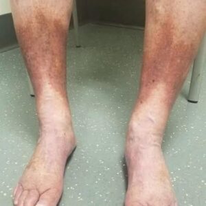 SAY GOODBYE TO VARICOSE SAY GOODBYE TO VARICOSE