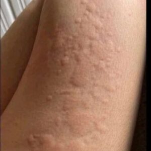 When an Itch Isn’t Just an Itch: James’s Story and the Silent Warning Signs of Skin Conditions