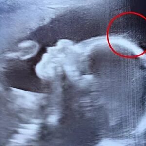 HomeDoctors couldn’t believe what they saw during the ultrasound. But when the baby girl was born, her charm, strength, and story touched hearts around the world in the most unexpected way HomeDoctors couldn’t believe what they saw during the ultrasound. But when the baby girl was born, her charm, strength, and story touched hearts around the world in the most unexpected way