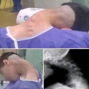 A Life-Altering Incident: Heavy Object Falling on Head Caused Fatal Cervical Spine Fracture in 18-Year-Old Worker