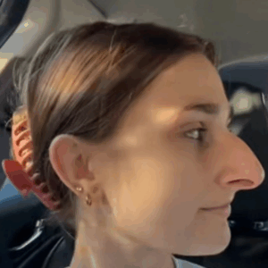 A Woman Shares the Results of Her Plastic Surgery, and the Transformation Has Everyone in Awe A Woman Shares the Results of Her Plastic Surgery, and the Transformation Has Everyone in Awe