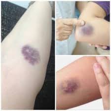 BE CAREFUL, if you get these bruises on your body, it means you have Ca…see more BE CAREFUL, if you get these bruises on your body, it means you have Ca…see more