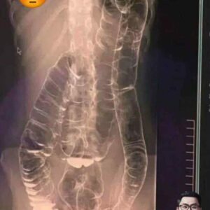 Everything you need to know about chronic constipation: A hidden threat to your digestive health