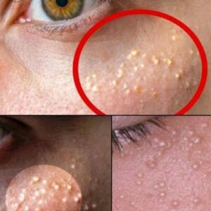 Tiny White Bumps on Your Face? Here’s What They Are—And How to Treat Milia Naturally and Safely at Home