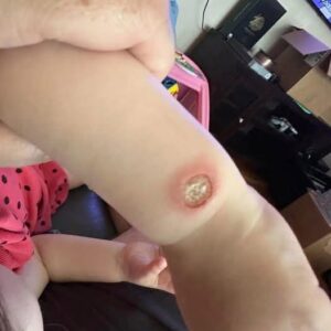 Unusual Case of Sweet Syndrome Triggered by New Inhaler Therapy in Primary Care
