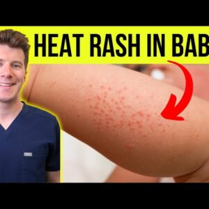 Doctor explains HEAT RASH (miliaria) in a baby | Causes, symptoms, treatment and prevention