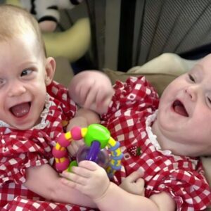 Doctors separated conjoined twins born connected at the chest: Here’s what they look like 25 years later