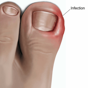 How to Treat an Ingrown Toenail at Home: Tips and Natural Remedies