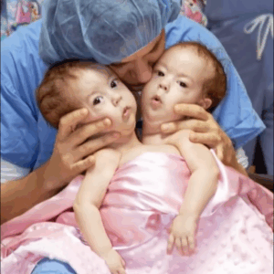 Conjoined Twins Bella And Abby Were Genuinely Associated From Birth, Yet Medical Procedure Changed Everything