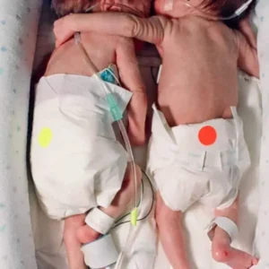 Nurse Puts Dying Baby Next To Her Twin. She Gives Her A ‘Hug’ That Leads To A Miracle