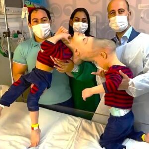 These brothers from Brazil were born with their heads fused together and had to share not only vital blood vessels but also parts of their brains.
