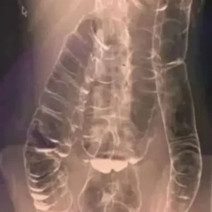 Everything you need to know about chronic constipation: A hidden threat to your digestive health