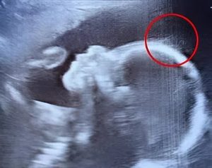 Doctors couldn’t believe what they saw during the ultrasound