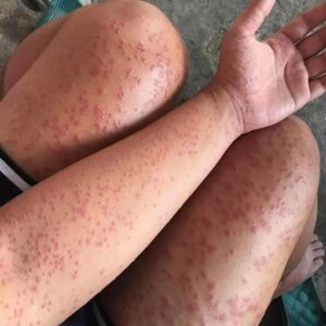 I Slept at my friends old apartment for a couple days noticed these weird bump…