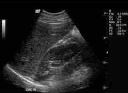 Son who donated part of h