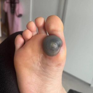 My daughter woke up with this huge spot on her foot I don’t know what it could be. She’s been in pain and can’t move her foot what is this..
