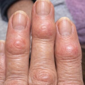 Swollen Feet: Common Causes, Warning Signs, and When to Seek Medical Advice