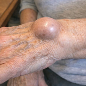 Doctors reveal that if you develop this strange lump on your wrist overnight, it means that you have …