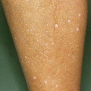 What Vitamin Deficiencies May Lead to White Spots on the Skin