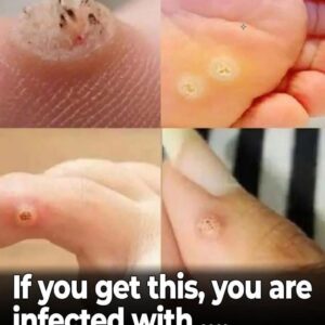 6 Types of Warts (Signs, Symptoms, Home Remedies, and Treatment)