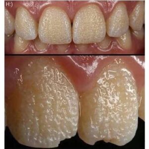 Be Careful! This Is What Can Happen to Your Teeth When You Eat Certain Everyday Foods and Drinks That Slowly Damage Enamel