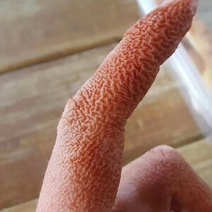 ALERT: Rare Skin Reaction Linked to Inhaler Change Raises Medical Awareness