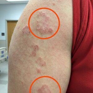 If you see red marks appearing on your arm, that’s a sign of ca…