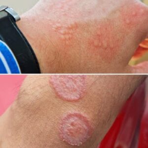 Common Signs of Groin Skin Irritation
