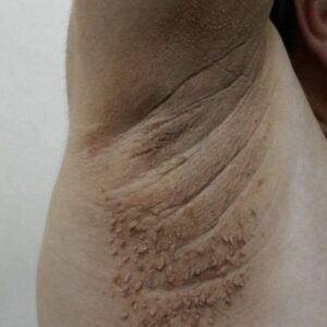 Understanding Dark Patches on the Skin: A Gentle Guide to Acanthosis Nigricans and When to Seek Care